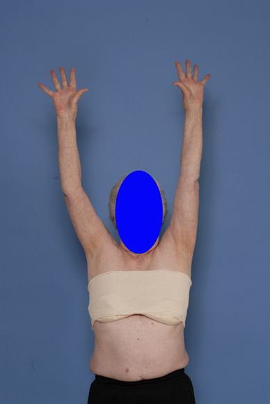 Photo showing excellent range of motion postoperatively